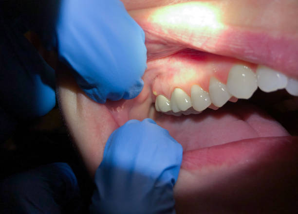 Best Emergency Dentist for Lost Fillings or Crowns in Elliston, VA
